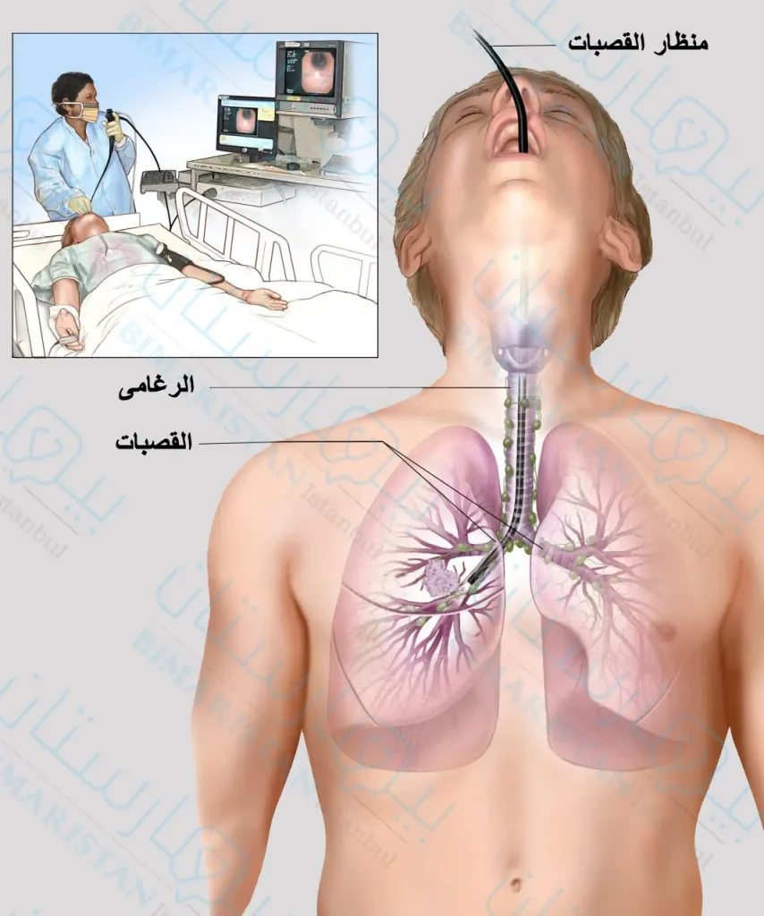 How to perform a bronchoscopy, which is done by inserting the endoscope into the mouth and from it to the farthest airways