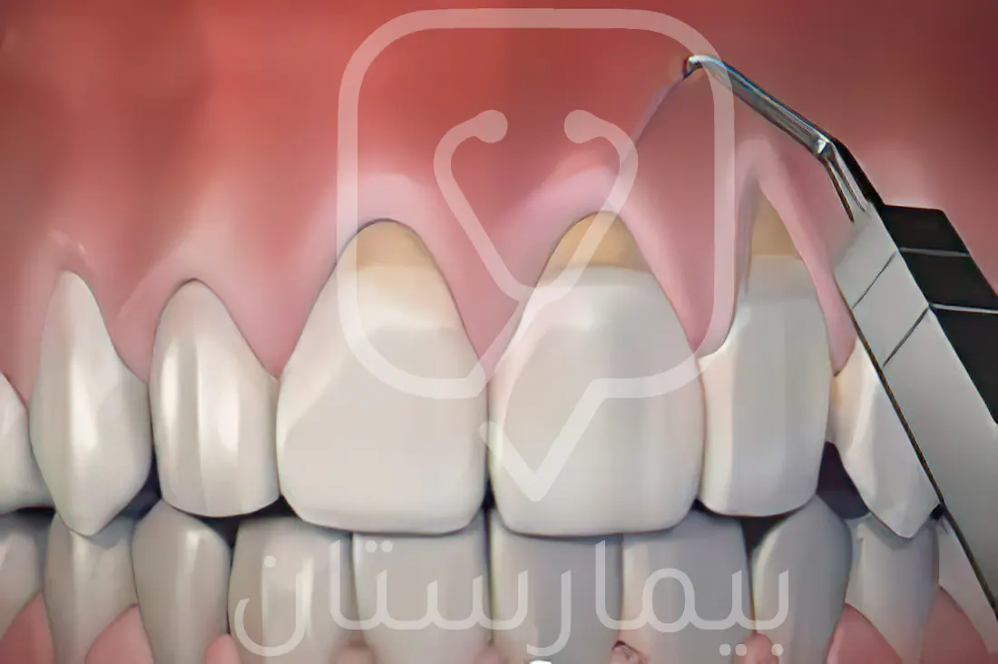 Puncture or tunnel technique for periodontal surgery in Turkey