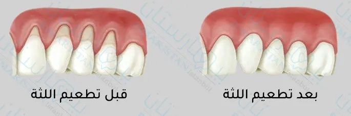 Diş eti implantasyonu öncesi/sonrası