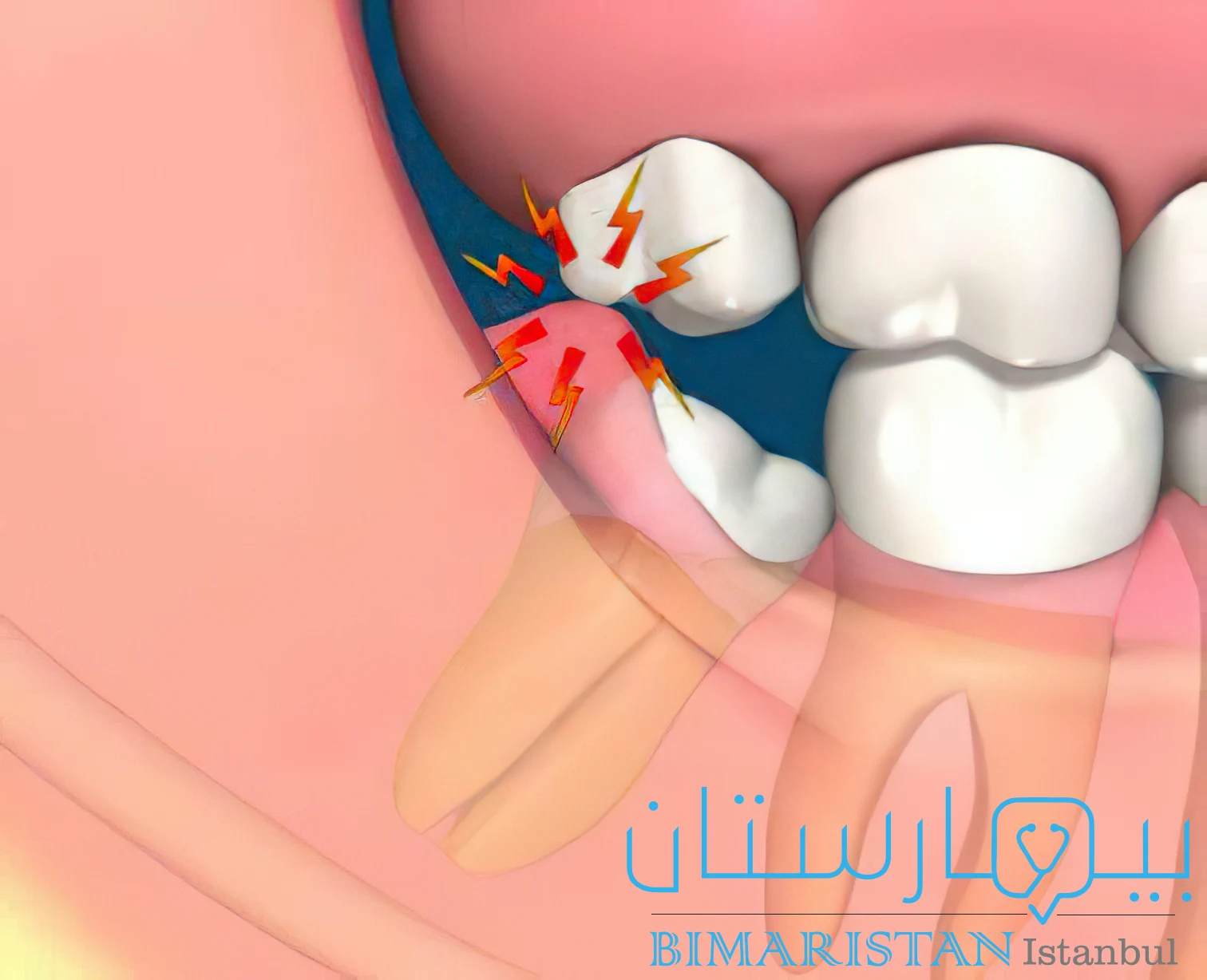 Pericoronitis as a result of gum trauma due to the opposite tooth