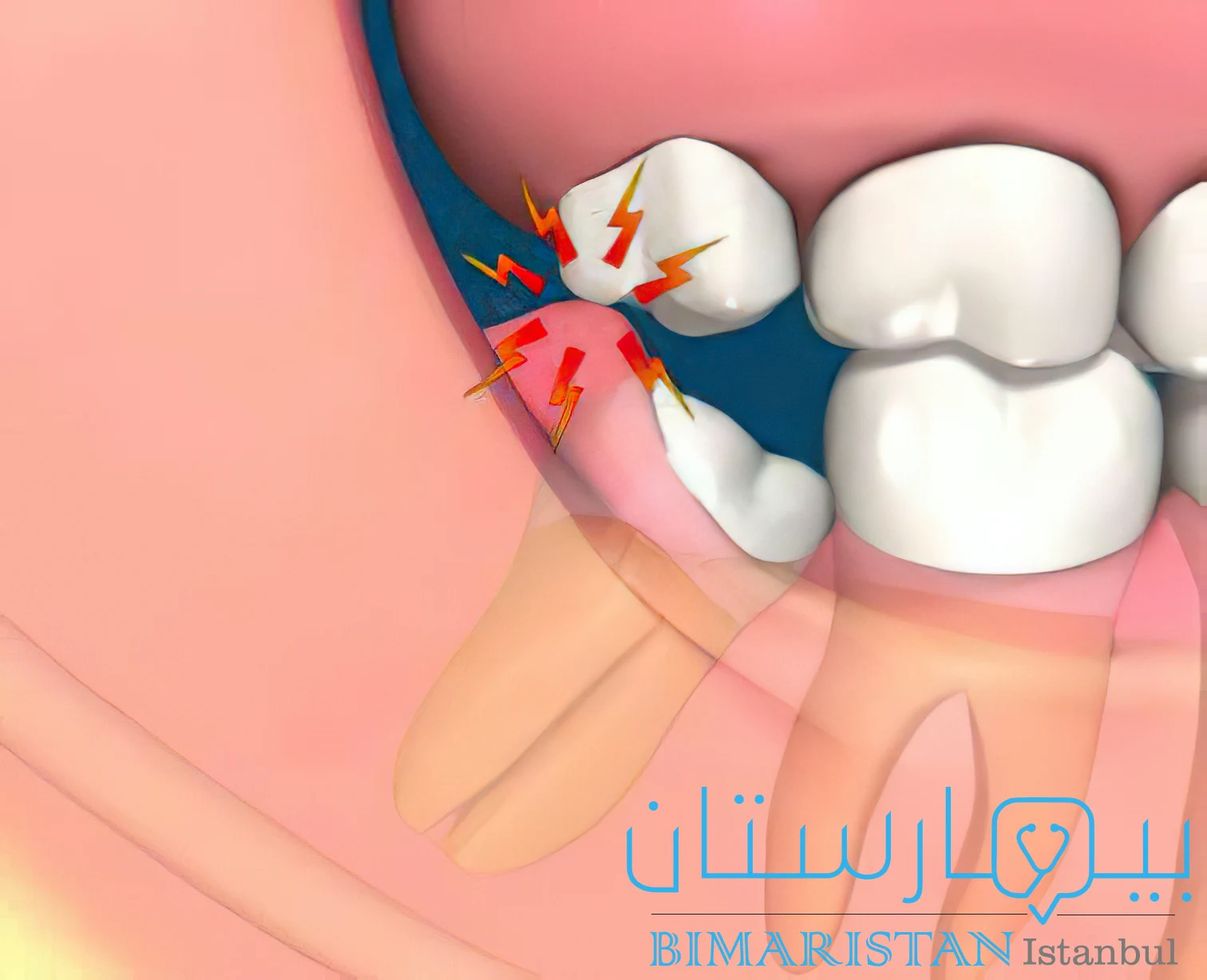 pericoronitis infection