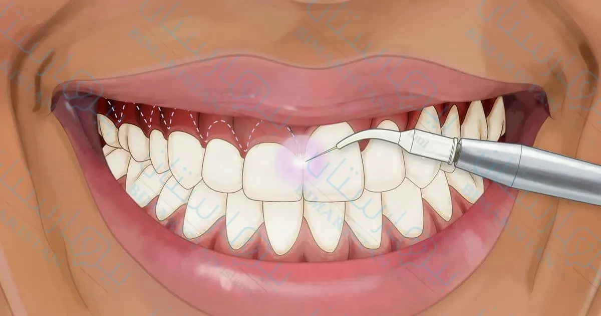 علاج الابتسامة اللثوية بالليزر في تركيا