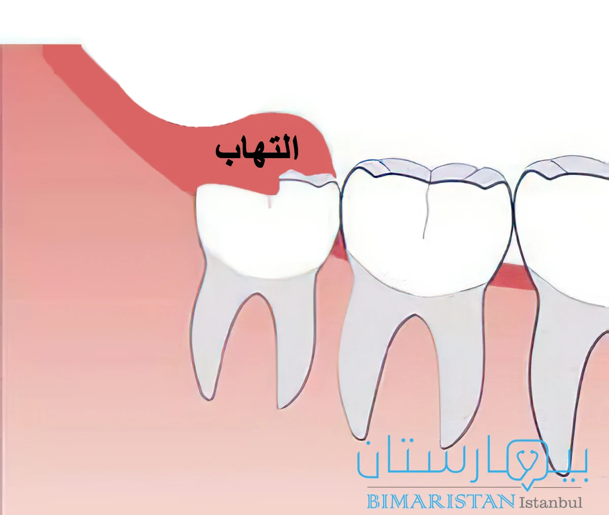 علاج التهاب ماحول التاج في تركيا