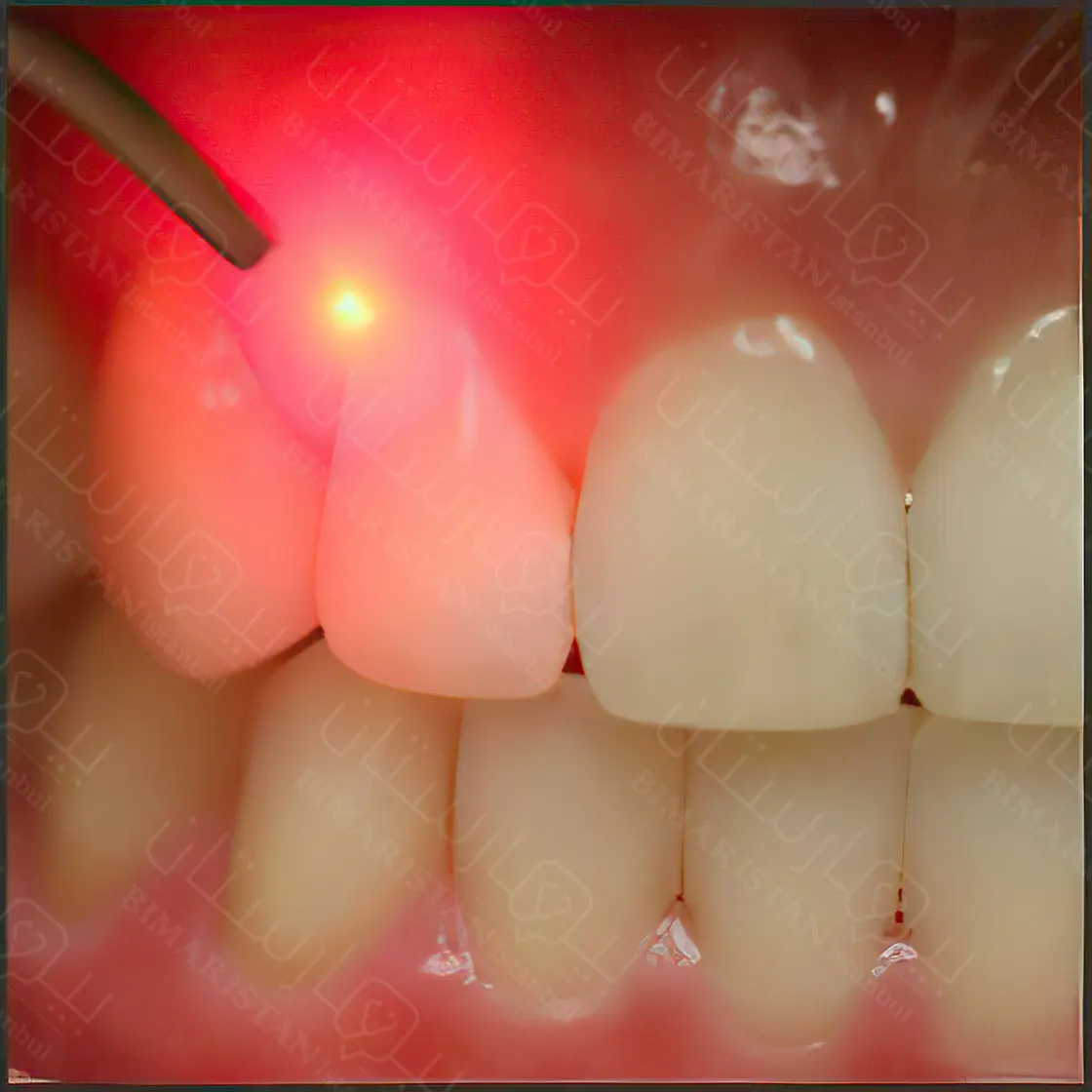 Laser gum treatment