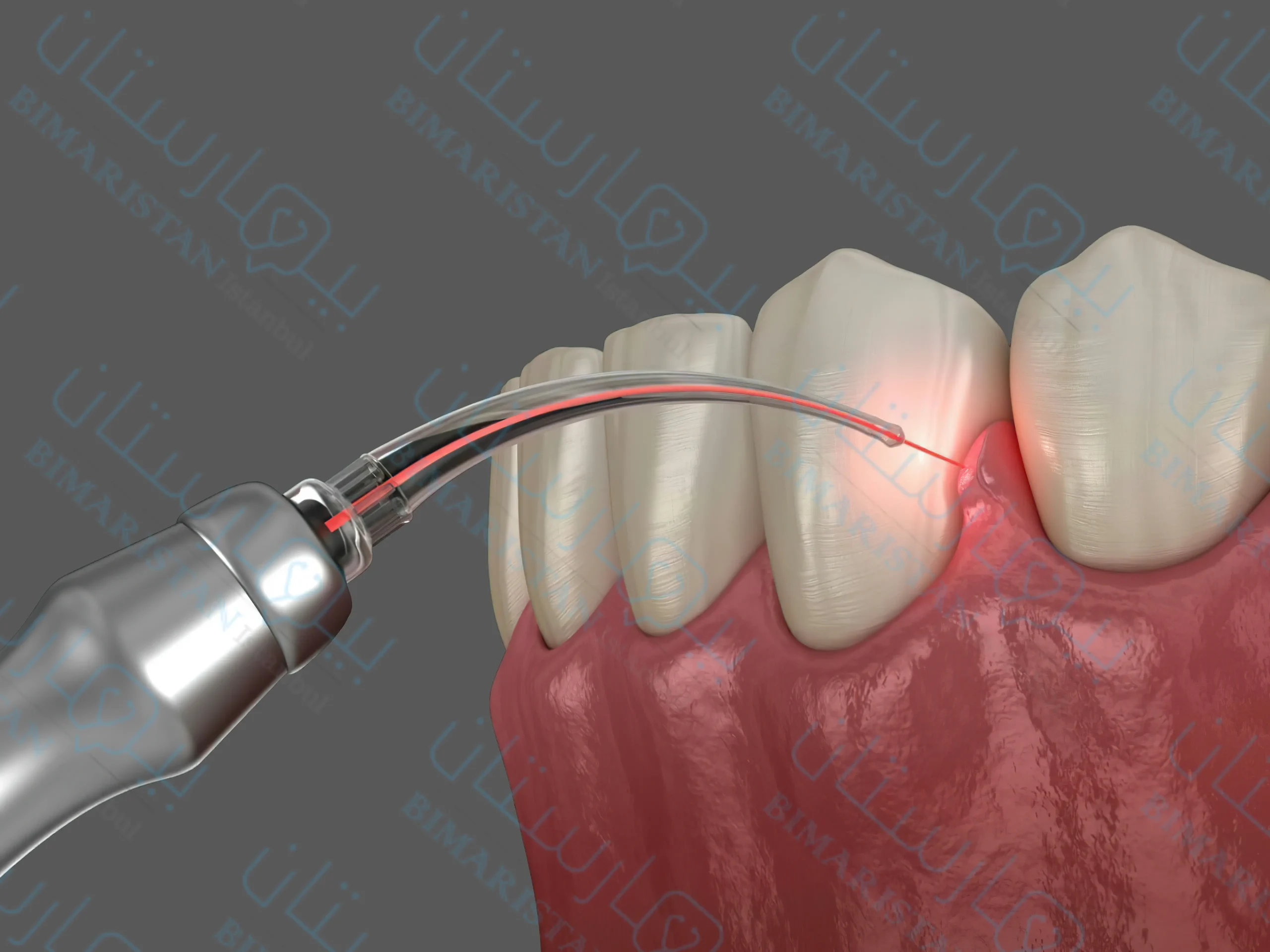 Laser dental treatment methods in Turkey