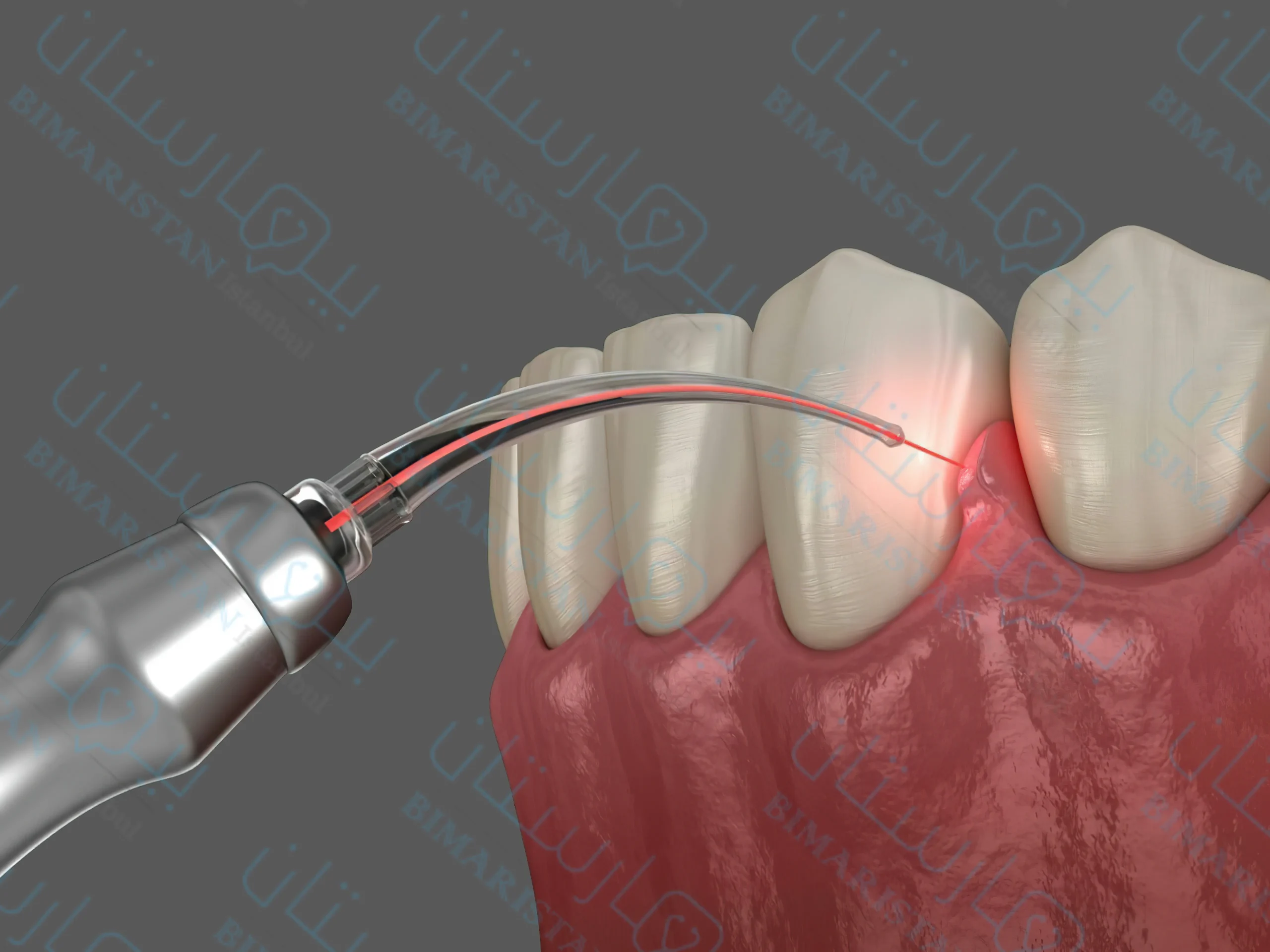 جراحة اللثة: لعلاج تراجع اللثة وتجميلها في تركيا - بيمارستان