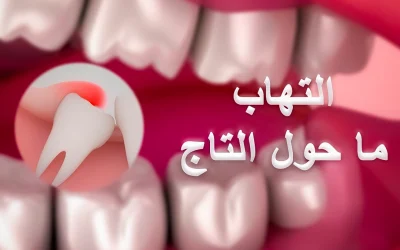 Treatment of pericoronitis in the teeth