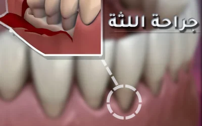 Gum surgery: to treat and beautify gums in Turkey
