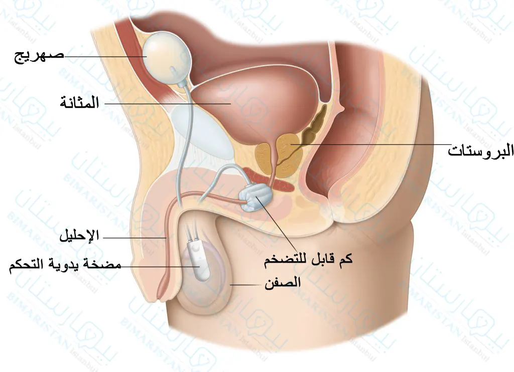 Treatment of urinary incontinence in men by artificial urinary sphincter