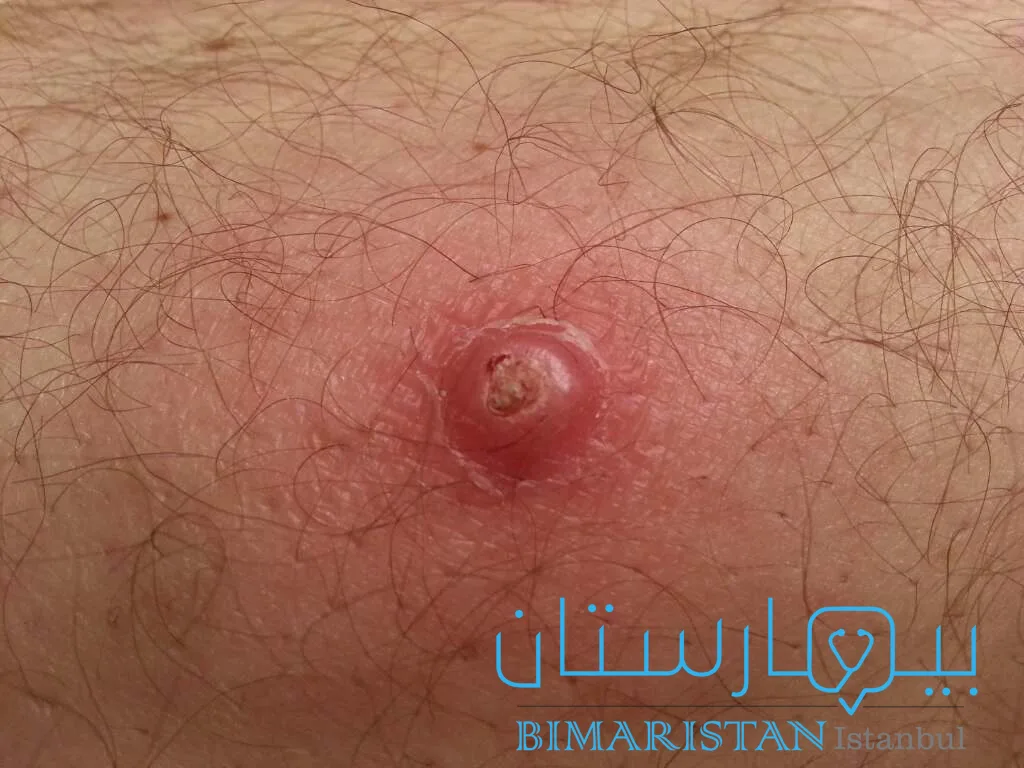 Skin cancer (squamous cell carcinoma)