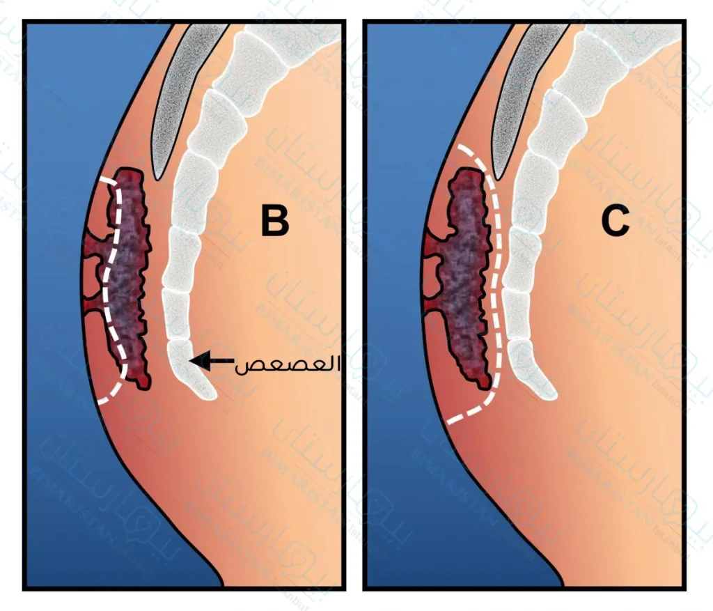 A picture showing the types of operation to remove a pilonidal cyst