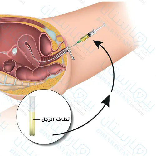 Intrauterine injection
