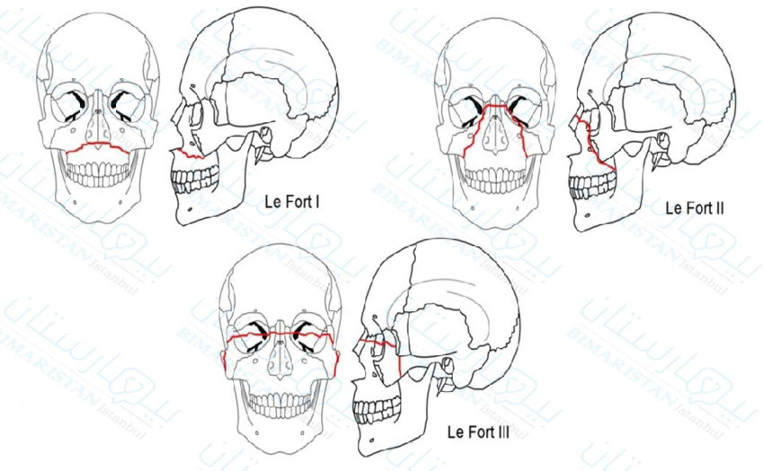 Le Fort classification for facial fractures