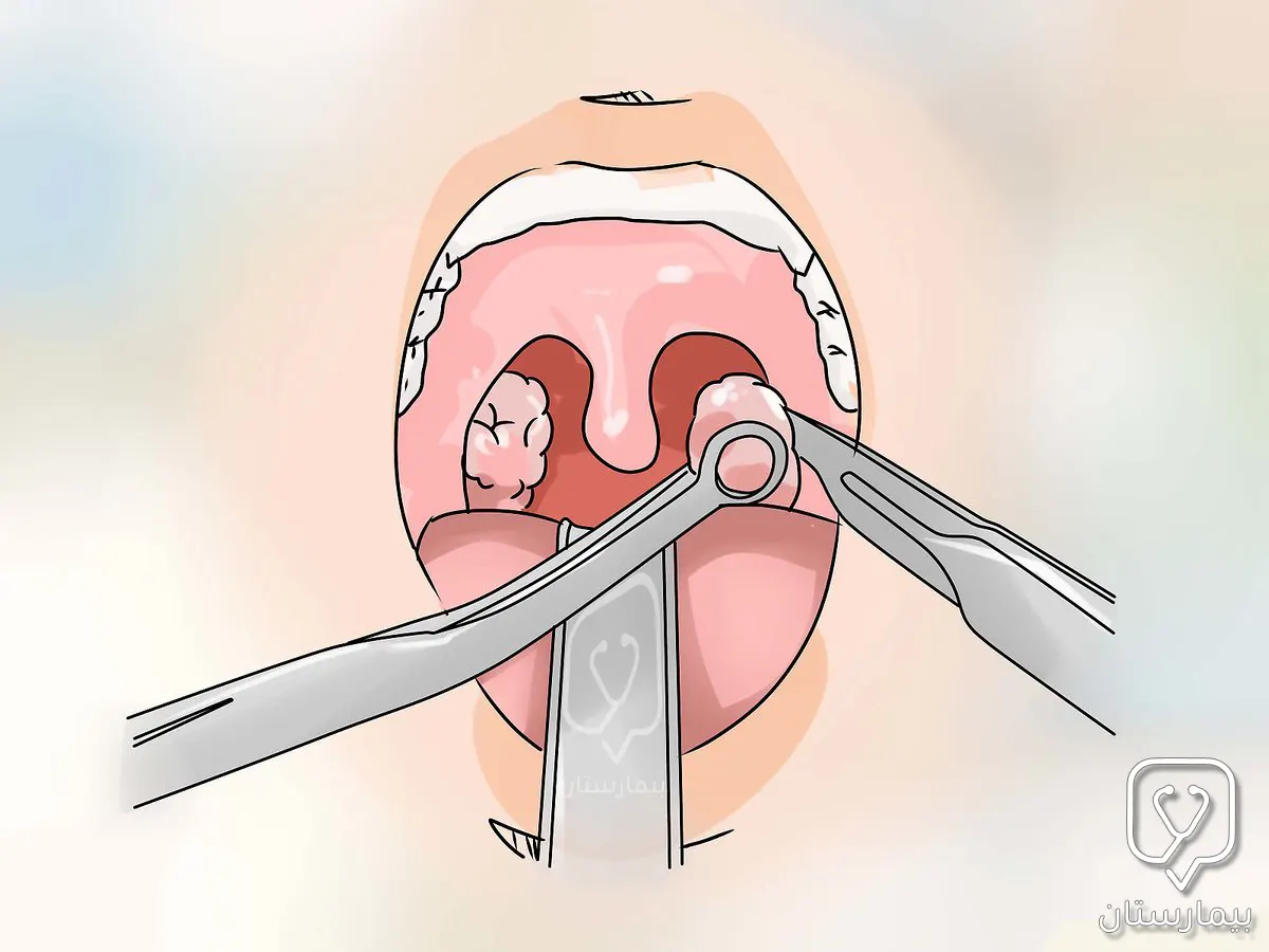 يقوم الجراح بفصل اللوز الملتهبة عن مجاوراتها بواسطة المشرط ويطلق على ذلك عملية استئصال اللوزتين