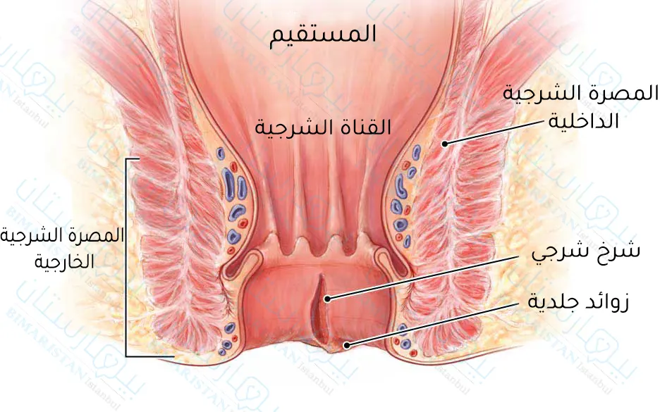 شرخ شرجي في القناة الشرجية مع زوائد جلدية عند فتحة الشرج