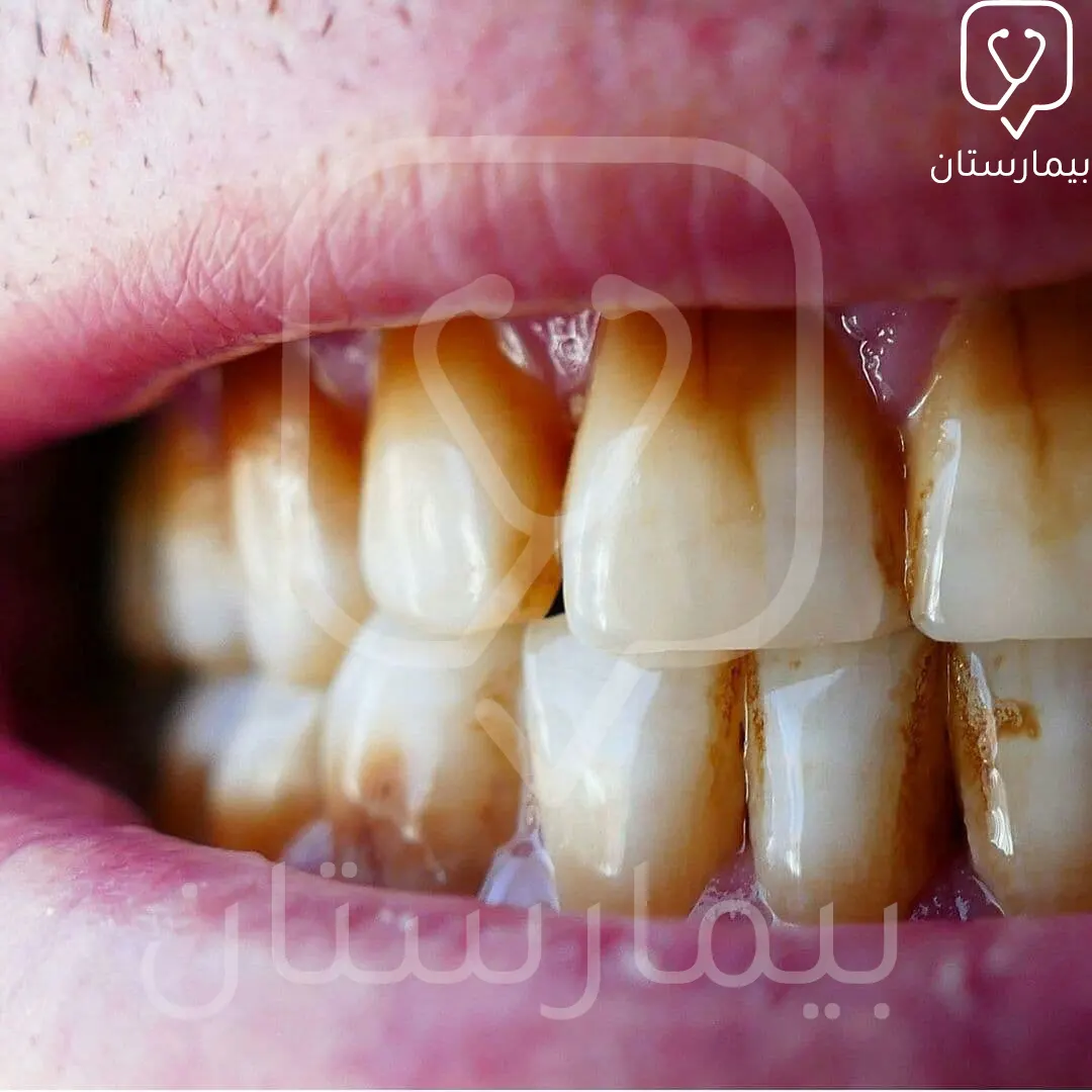 The effect of smoking on the mouth and teeth is demonstrated here by pigmentation of the teeth.