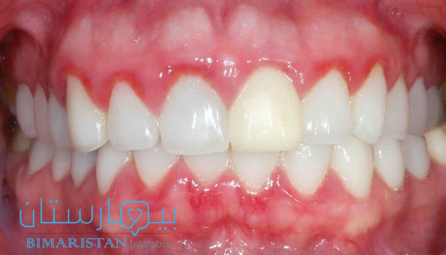 Gingivitis is one of the causes of gum pain