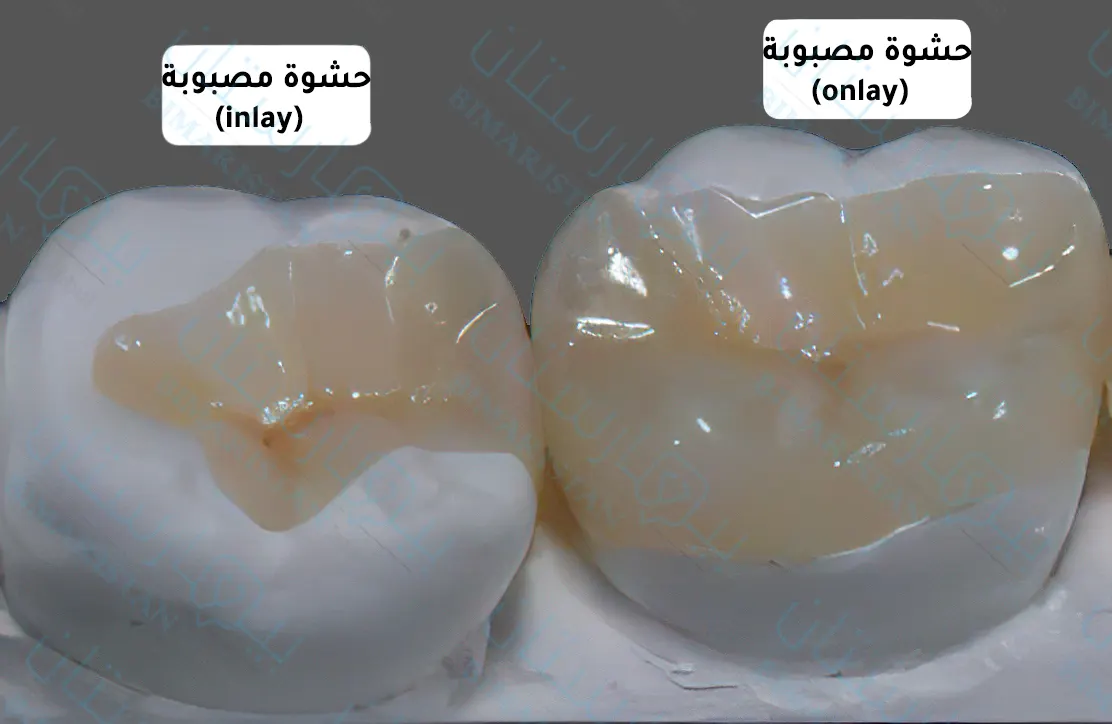 أنواع حشوات الأسنان المصبوبة الدائمة في تركيا