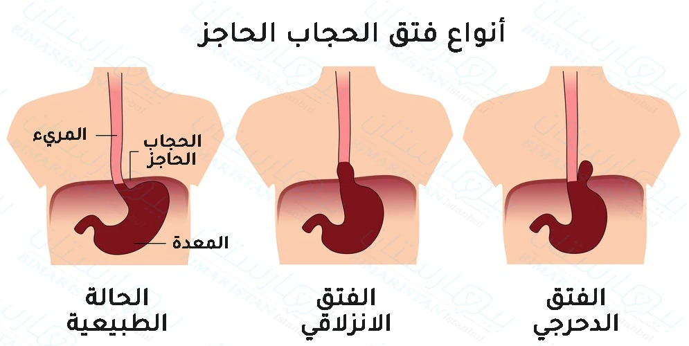 The three types of hiatal hernia and what happens in each type of hiatal hernia