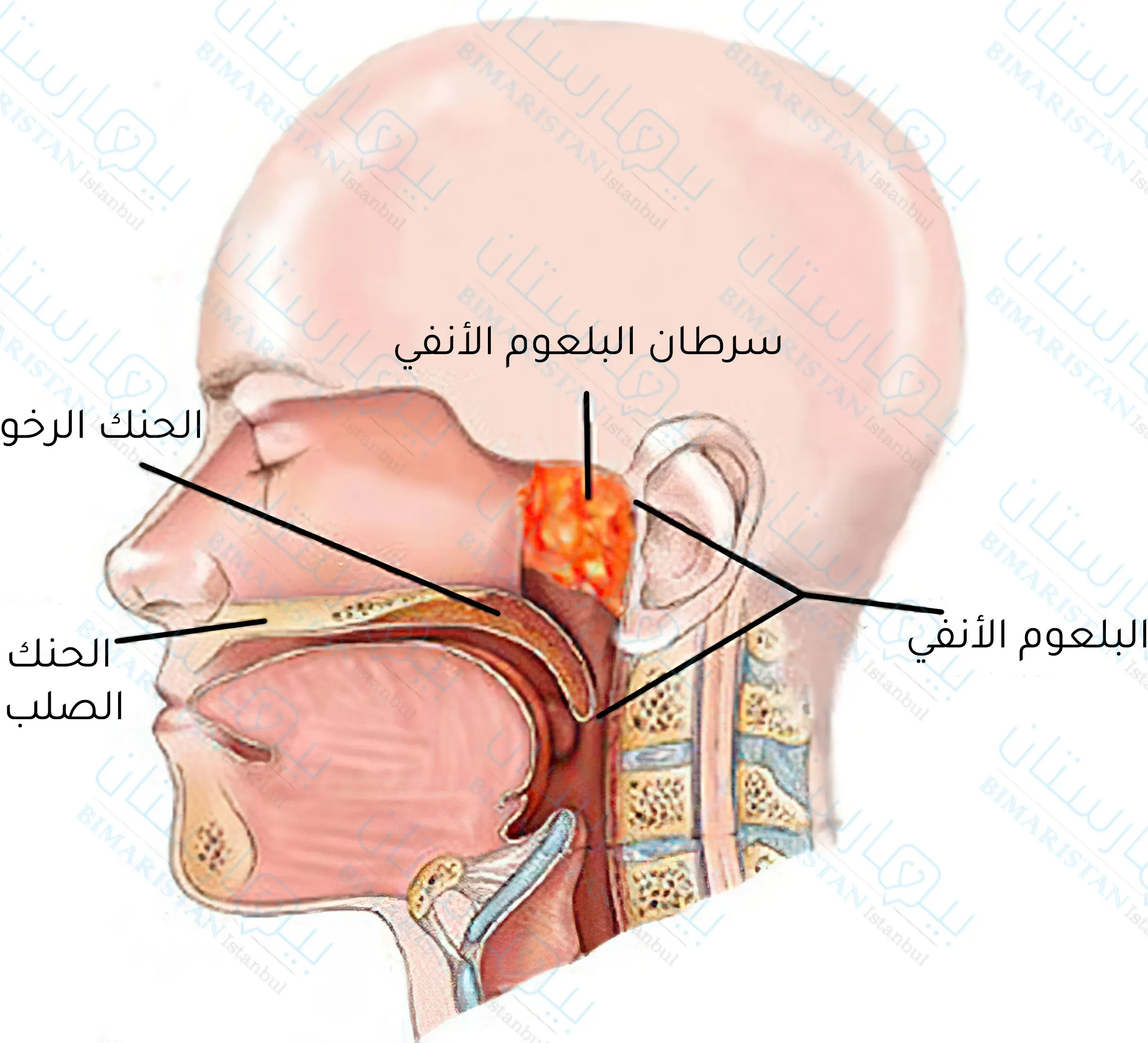 What is nasopharyngeal cancer?