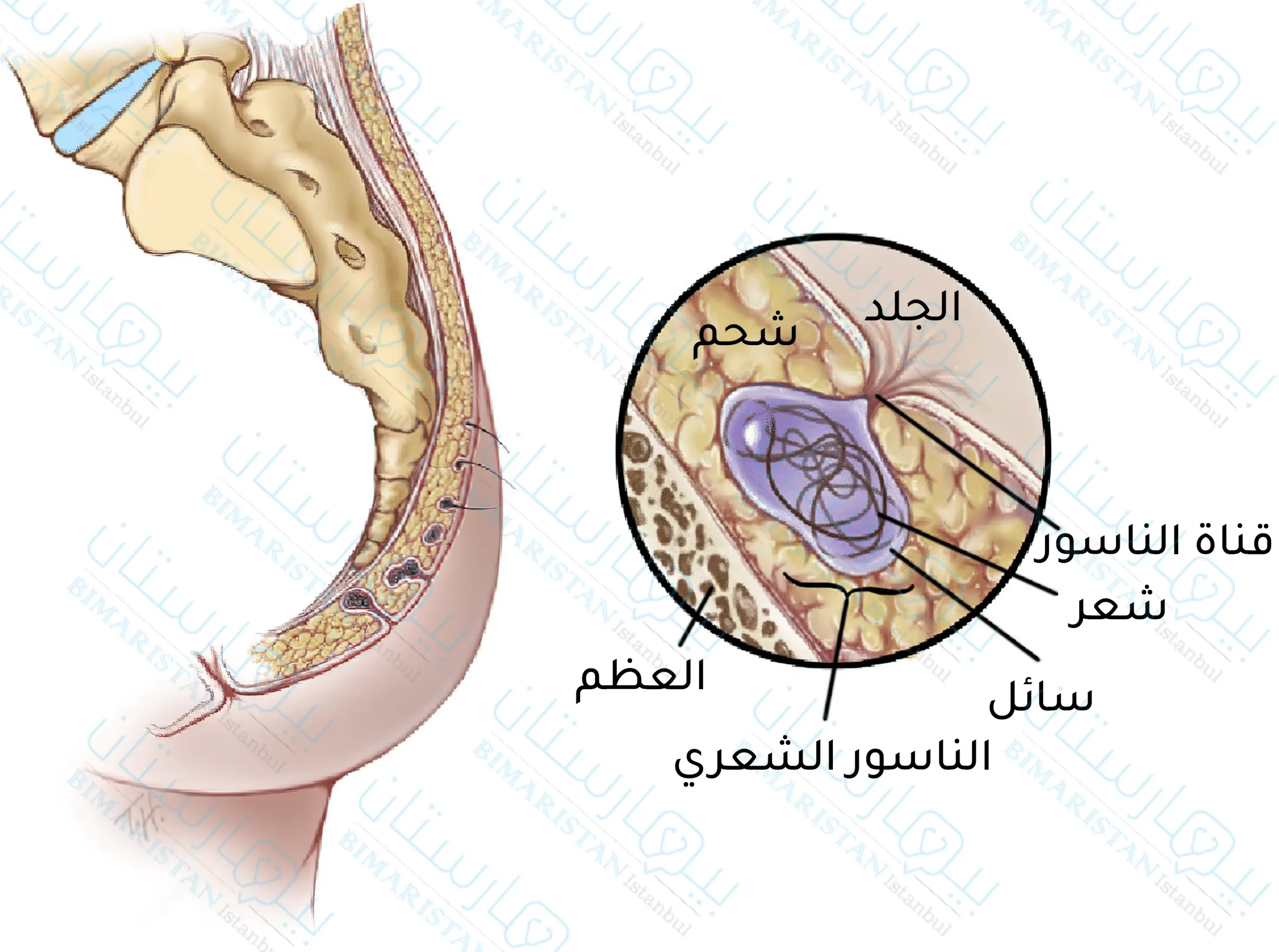 A picture showing the pilonidal sinus and its components and in which layer of the skin it most often arises