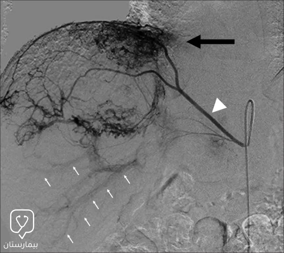 Contrast radiography of a liver tumor showing increased vascularization (as indicated by the large arrow) of the tumor due to the secretion of some angiogenic growth factors.