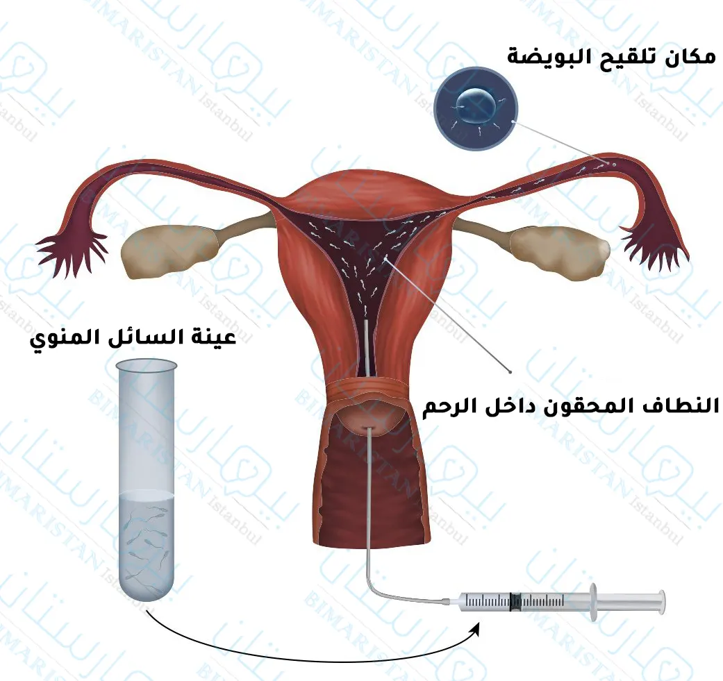 كيفية إجراء عملية التلقيح الاصطناعي (الحقن داخل الرحم)