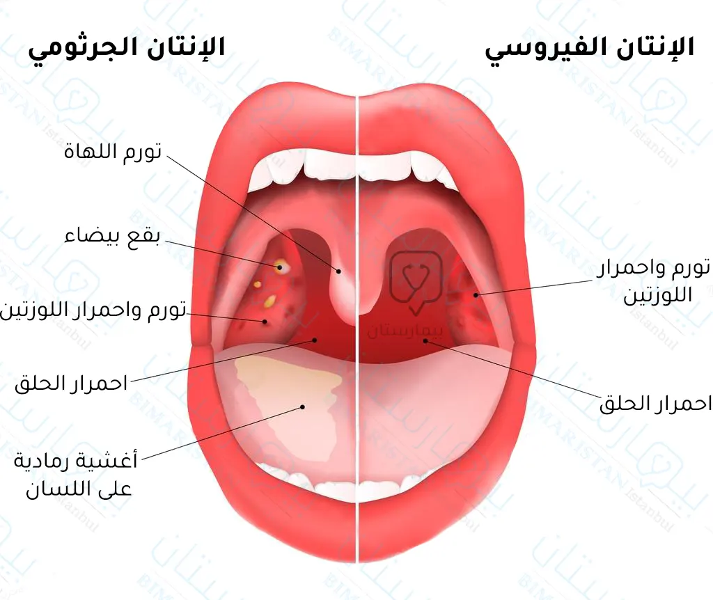 Adult bacterial tonsillitis is characterized by white spots on the tonsils and grayish membranes on the tongue