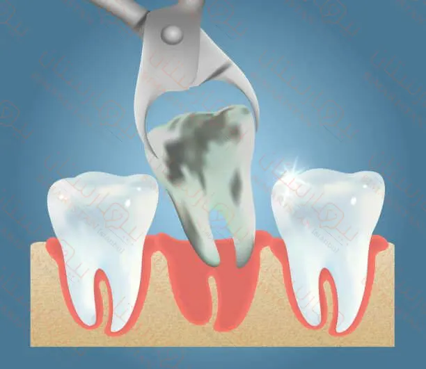 Tooth extraction process