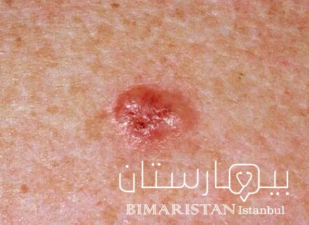 Skin cancer (basal cell carcinoma)