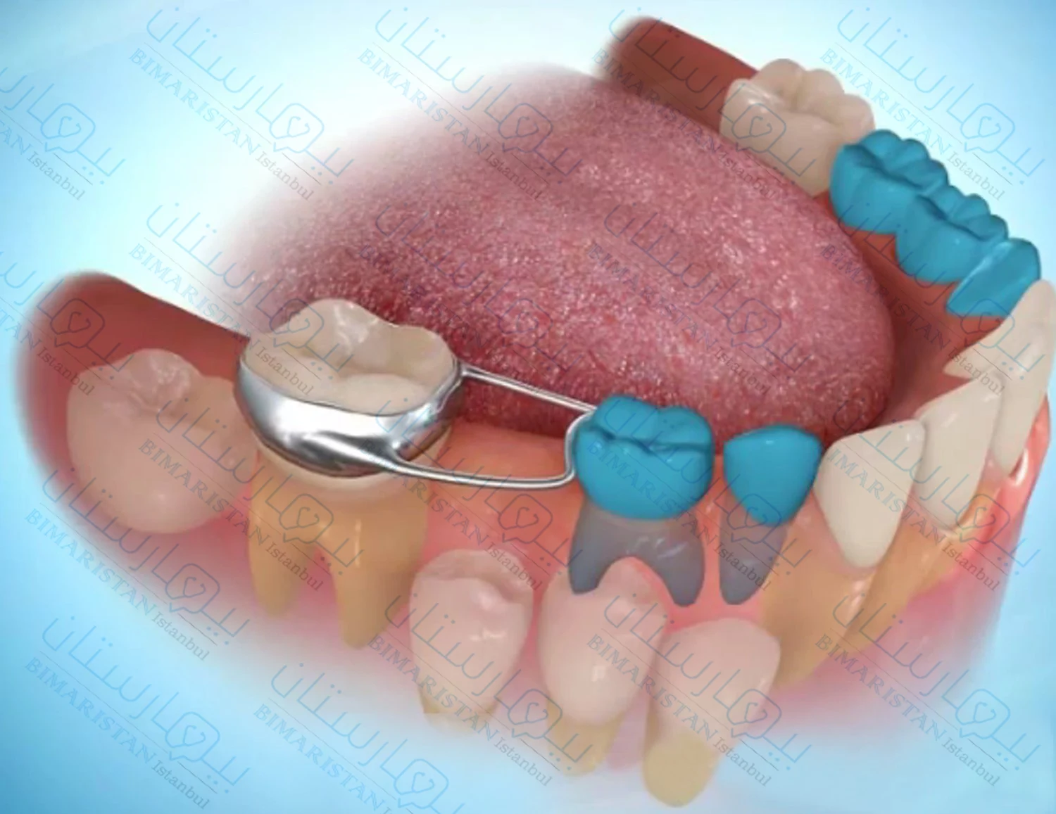 حافظة المسافة لمنع تحرك الأسنان واختلال الإطباق عند الأطفال من إجراءات طب أسنان الأطفال المهمة