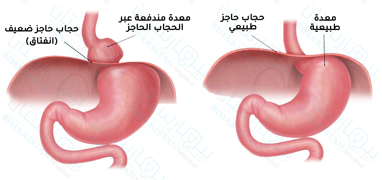 Comparison of normal and hiatal hernia, where the herniated diaphragm rises out of its normal position