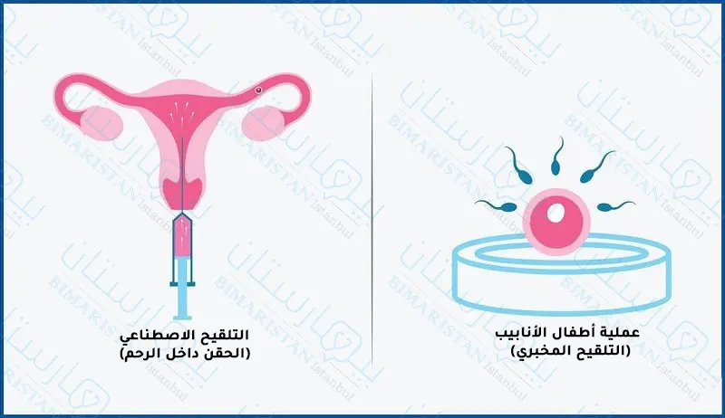 Comparison of IVF and IVF process