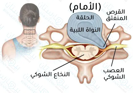 Cervical disc herniation
