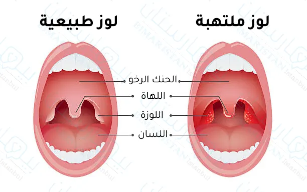 Tonsil pictures | Tonsillitis for adults