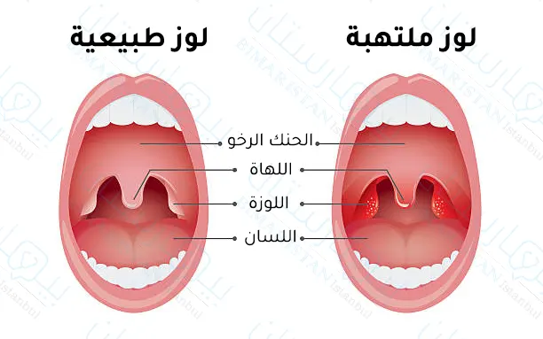 نلاحظ احمرار اللوز الملتهبة عند الكبار وتضخمهما