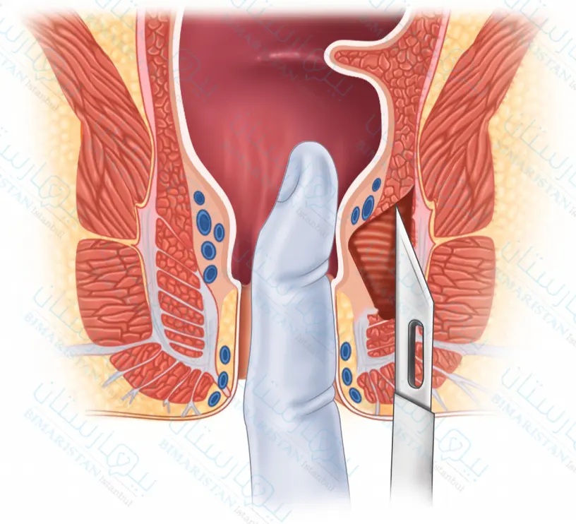 Treatment of chronic anal fissures through lateral internal sphincterectomy