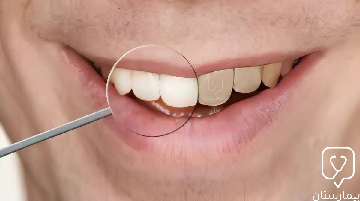 تأثير التدخين على الفم والأسنان يظهر بتلون الأسنان