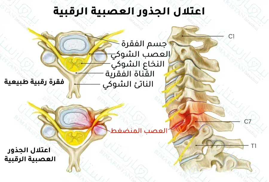 Disc neck symptoms Neuropathic radiculopathy
