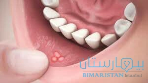 Mouth sores are one of the causes of gum pain