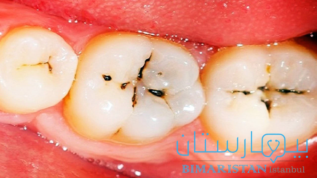 مناطق الخشونة السوداء تمثل نخور الأسنان