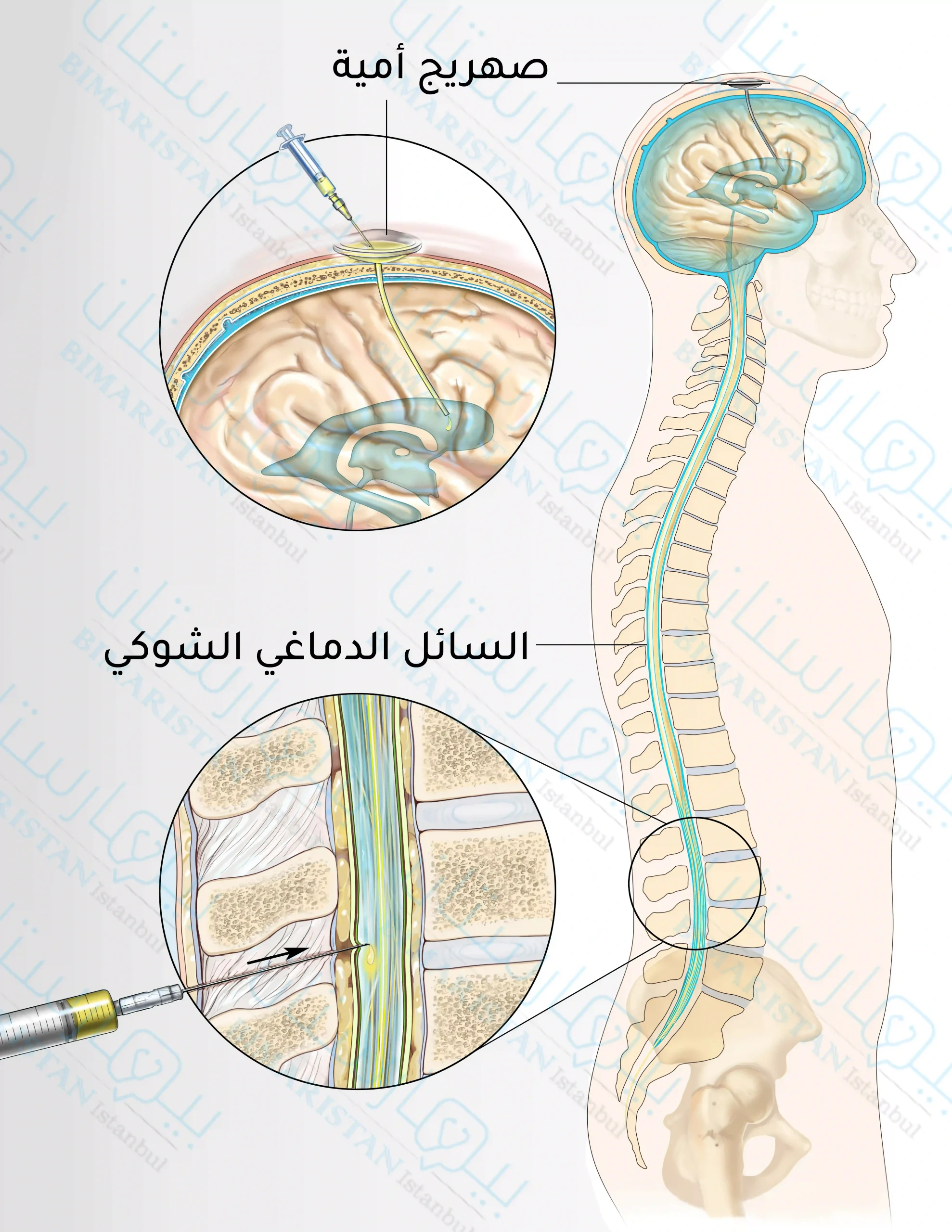Intrathecal injection of chemotherapy drugs into the spinal canal or subarachnoid space (the Ommaya Reservoir is the area where the cerebrospinal fluid drains).