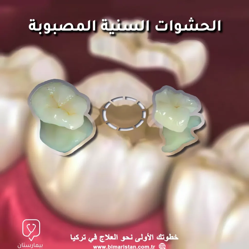 أنواع-حشوات-الأسنان-الدائمة-في-تركيا