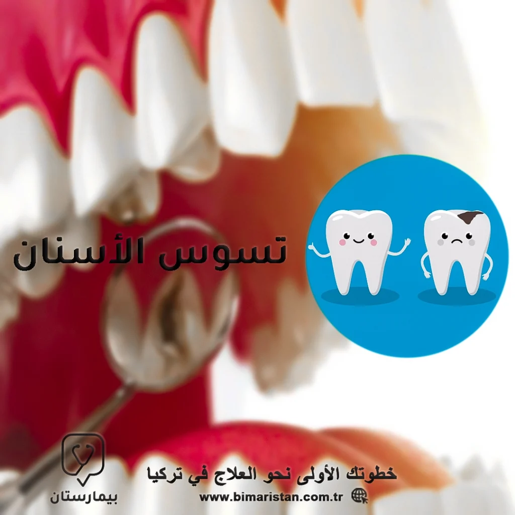 أنواع وعلاج تسوس الأسنان في تركيا