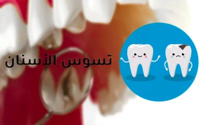 أنواع وطرق علاج تسوس الأسنان