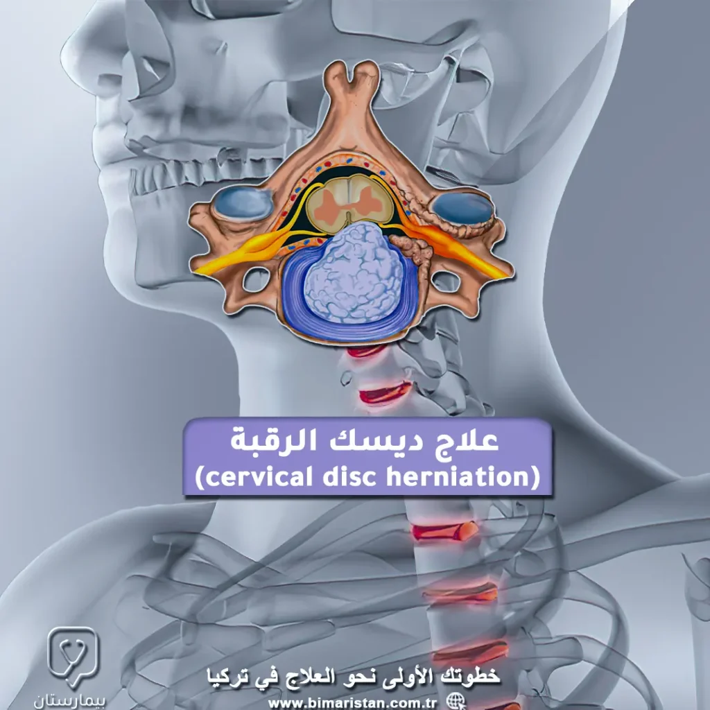 Find out how to treat a disc neck in Turkey