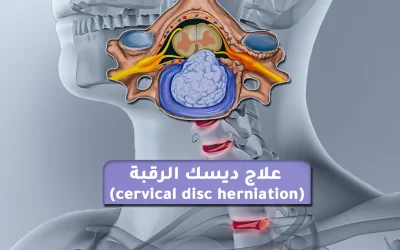 Find out how to treat a neck disc