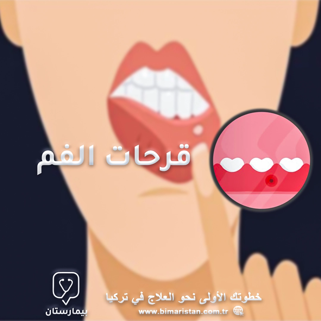 علاج تقرحات الفم ونصائح الوقاية من ظهورها