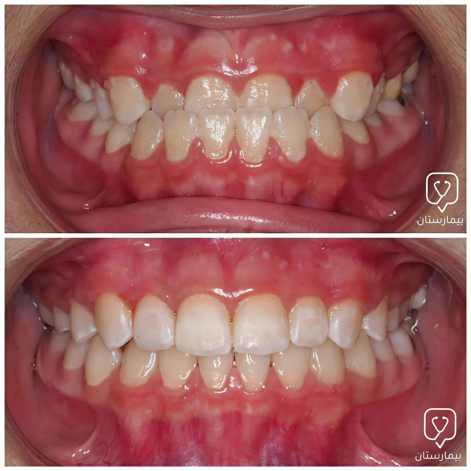 Before/After crossbite treatment