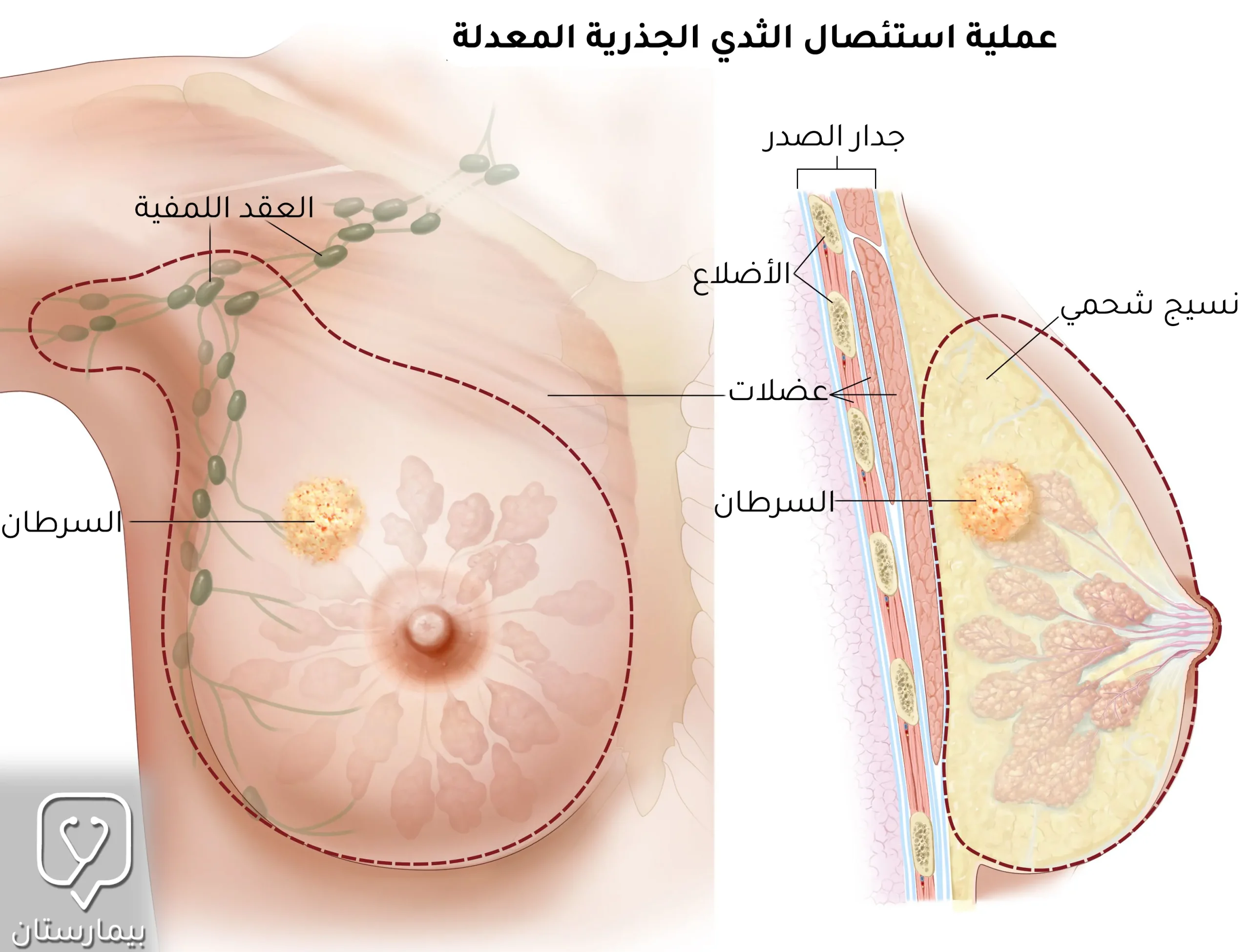 عملية استئصال الثدي الجذرية المعدلة